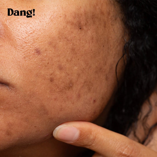How To Get Rid of Dark Spots on Face For Good: Your Ultimate Guide To Clear Even Toned Skin